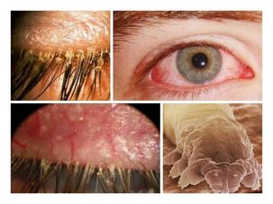 simptomi prisotnosti parazitov pod človeško kožo